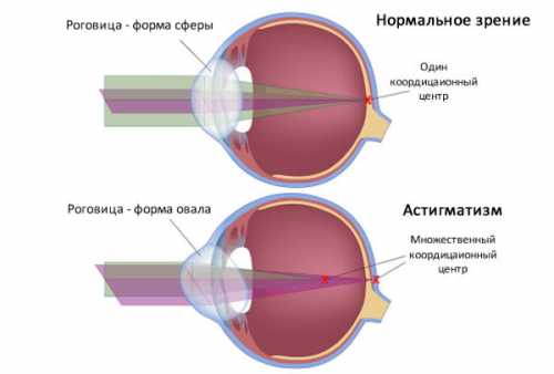 лазерная шлифовка: удаление растяжек