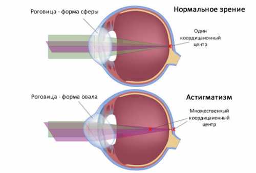 лазерная шлифовка: удаление растяжек