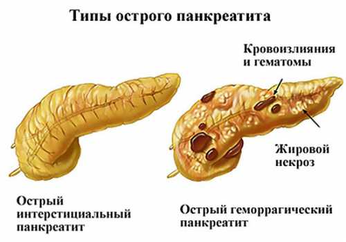 панкреатит диета: что вы можете и не можете есть, плюс советы и меры предосторожности